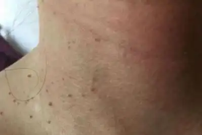 健康科普 | 脖子和腋下的小肉粒,到底是什么?