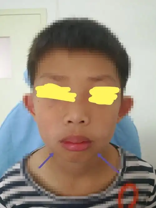 腺样体面容已经形成八岁半的孩子
