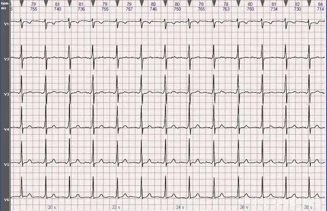 正常心电图图片图解