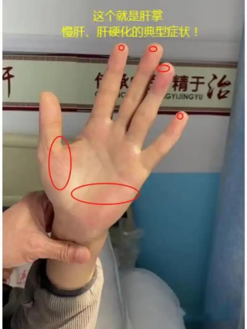 明显,这个就是肝掌!