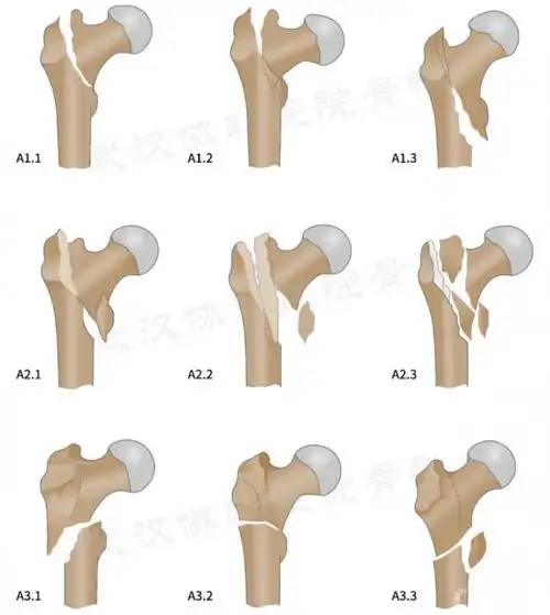 股骨转子间骨折ao分型操作方法在病人全身麻醉成功后进行手术.