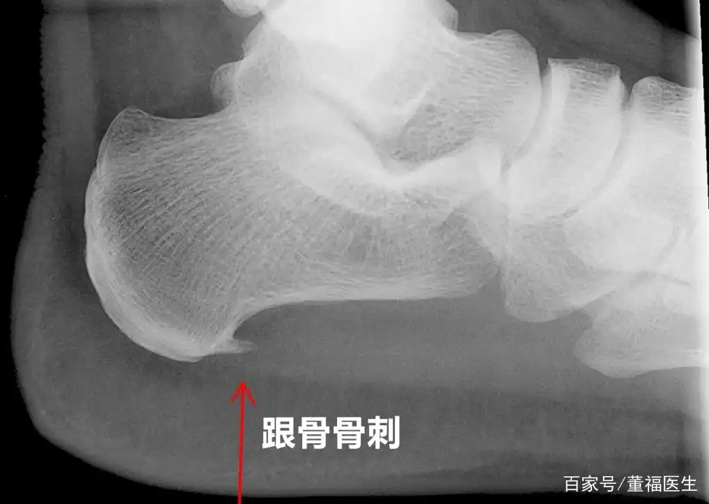 足跟痛是由跟骨骨刺引起的吗?真正的原因是什么?医生告诉您答案
