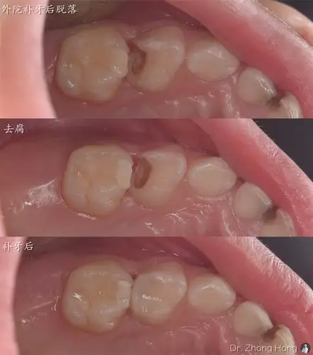 乳牙龋坏要补吗?