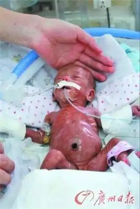 广东现最轻早产婴儿:重550克 身长30厘米(组图)-新闻频道-手机搜狐