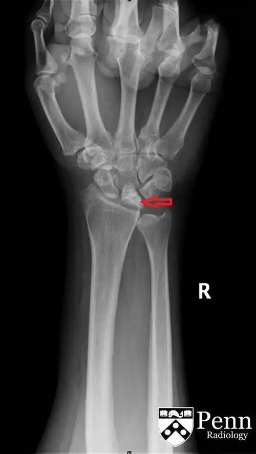 「断腕」之痛:月骨软化