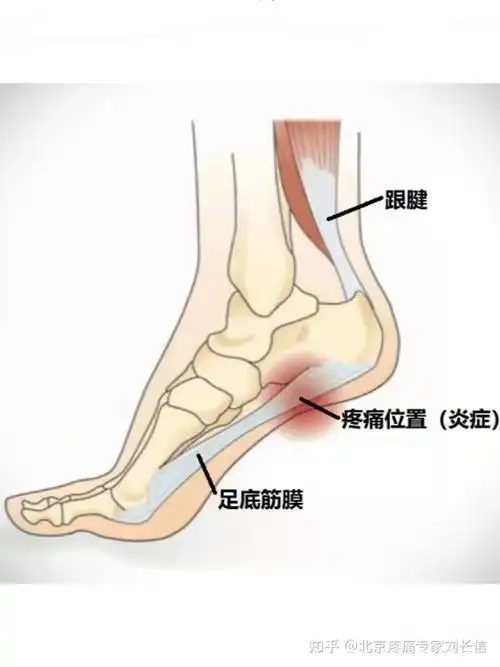 足底筋膜炎常见的四个症状看看你中招了没