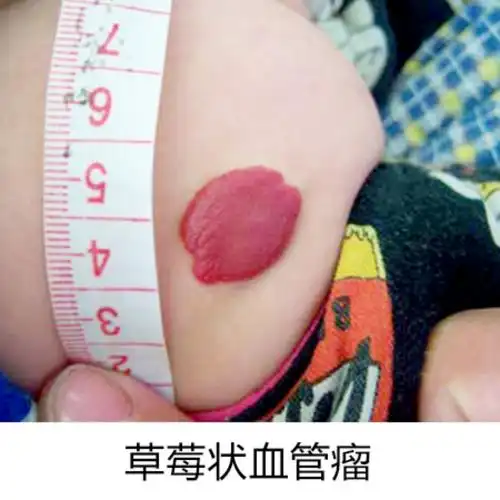 小孩身上出现红色斑块是血管瘤怎么办