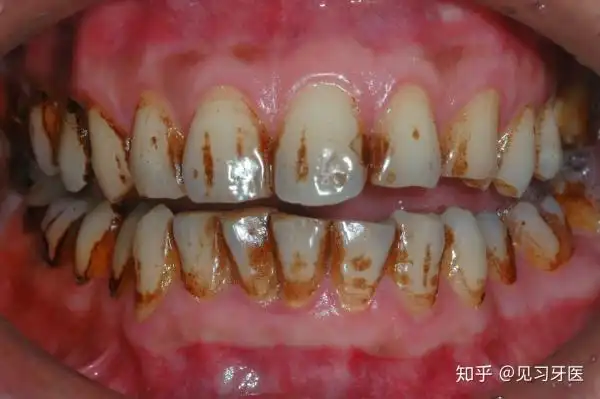 严重的外因性染色牙