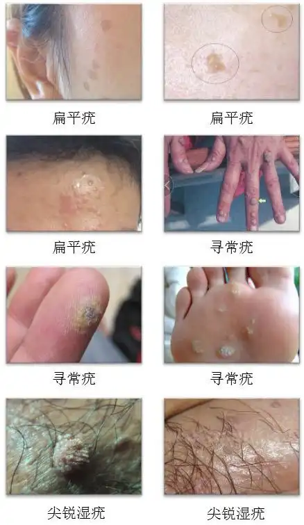 此外,临床上有许多治疗疣的方法.