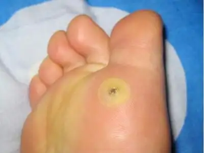 孩子脚上这个奇怪的肉刺是鸡眼吗