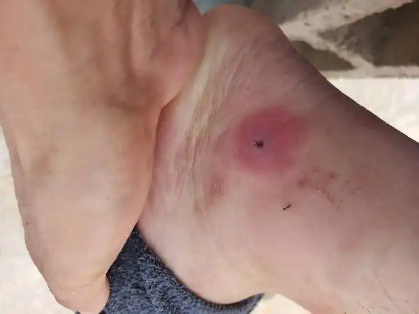 我在非洲尼日利亚拉各斯,不知是不是被虫子咬了,脚