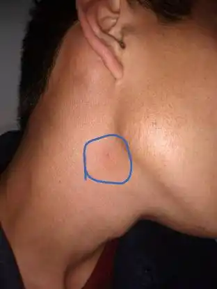 脖子皮肤上长个小包快两年了,有时有点痒用手抓又