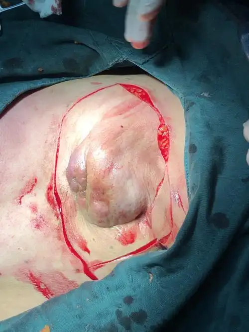 个案分享 重医附一院内分泌乳腺外科—背阔肌带蒂皮瓣