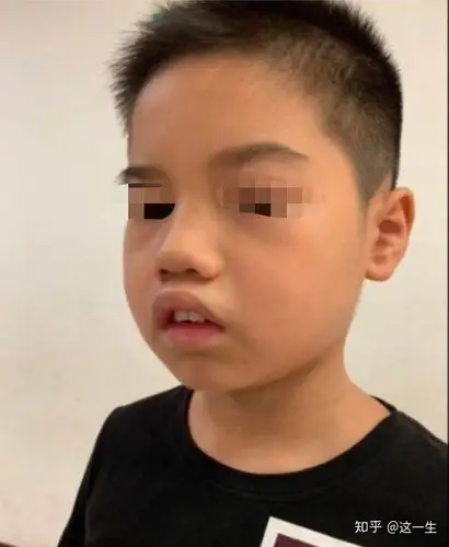 可怕的是长期的张口呼吸引起了腺样体面容,影响孩子的颜值.
