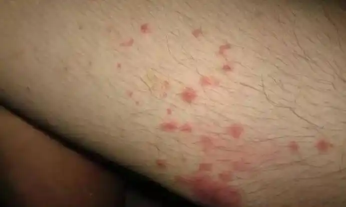 蜱虫咬人后有什么症状人被蜱虫咬伤口图片防治方法有哪些