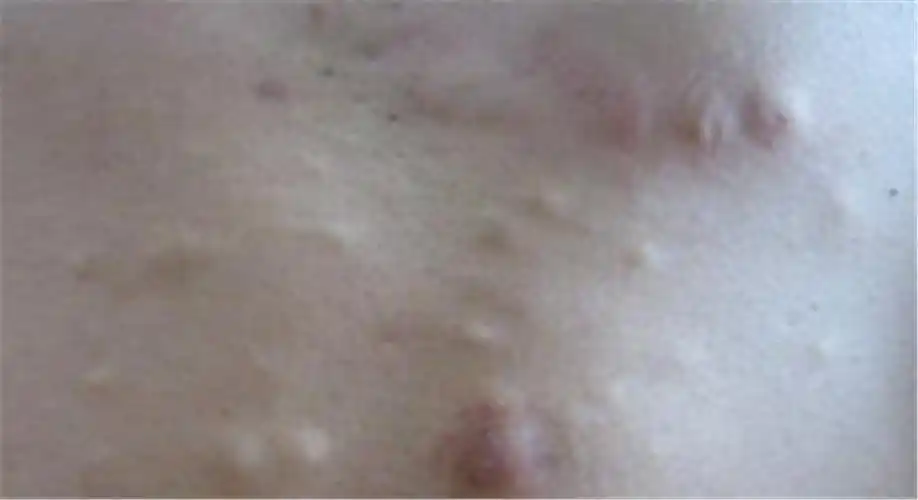 脂肪瘤图片图 (26)