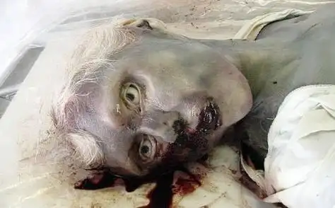 世界十大罕见的疾病,第一名竟然是笑死病(3)_巴拉排行榜