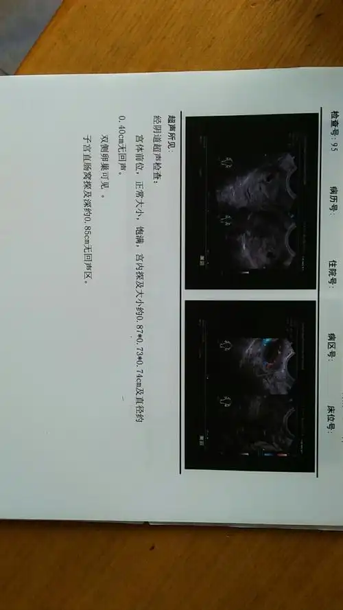 帮我看看这张b超图怀孕45天,正常吗?今天刚做的