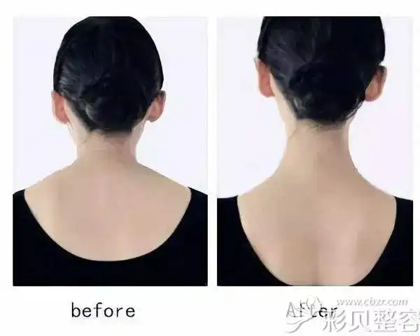 瘦脸除皱瘦肩效果好不好能保持多久用前后对比照片展示答案