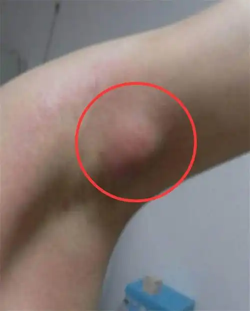 10岁男孩游泳后腋下起包奇痒难忍去医院医生钻得太深了