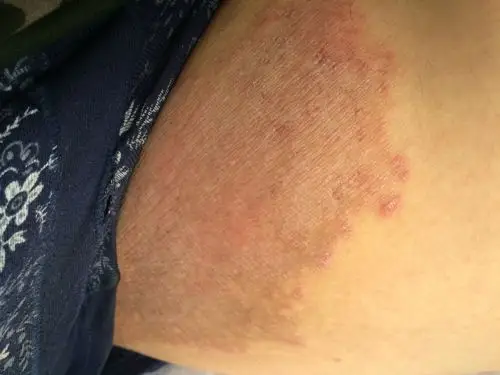 腹股沟这个皮肤病是怎么回事呢?