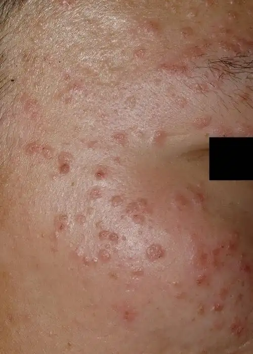 扁平疣症状和图片