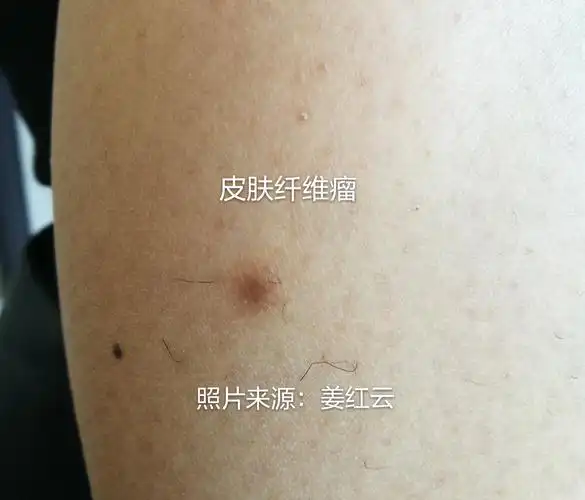 您了解皮肤纤维瘤吗? - 好大夫在线