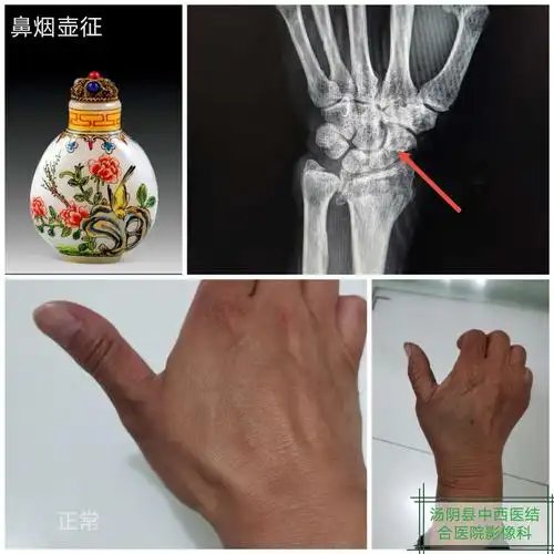 鼻烟壶征——手舟骨骨折