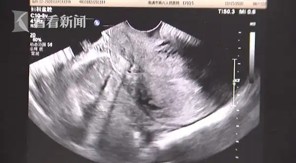 医生特别强调,怀孕6周一定要做超声波检查,即使诊断为宫内孕,如果出现