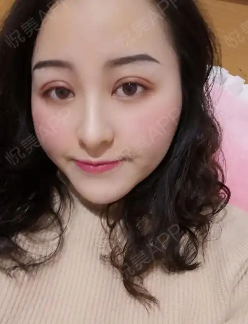 下睑下至术后7天_眼综合整形术后7天_全切双眼皮术后7天_眼型矫正术后