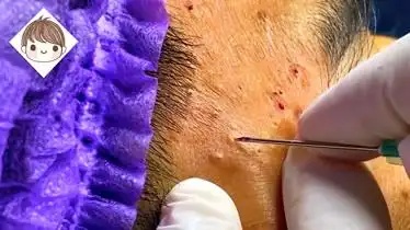 实拍阿姨挤黑头全过程,挤螨虫的过程让人酸爽,舍不得停下来!