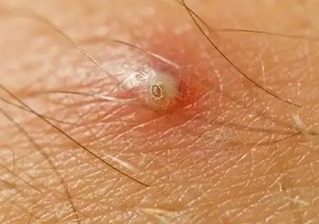 梅毒初期症状皮疹图片 梅毒一开始的征兆图片