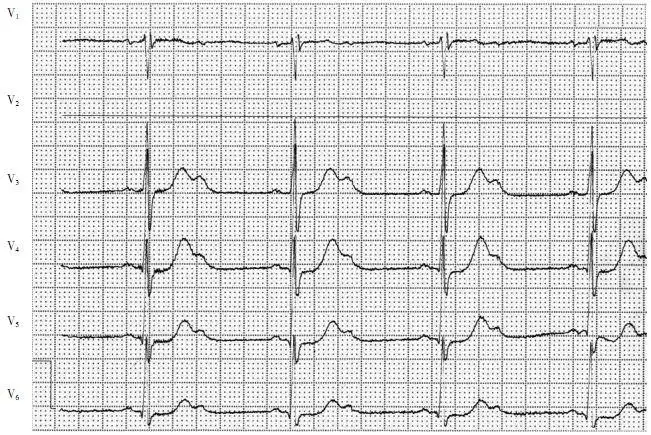 心电图教学查房:三度房室传导阻滞