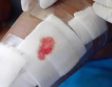 处理伤口纱布伤口.照片