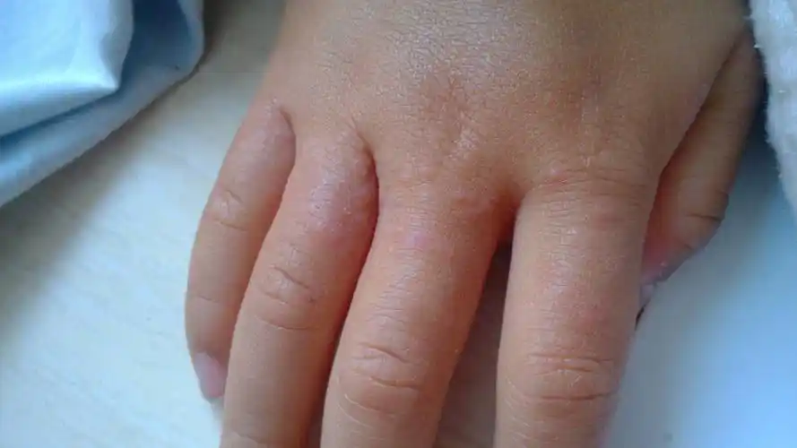 宝宝三岁半 最近手指上张了许多小疙瘩 还很痒 请帮忙 这是什么皮肤病