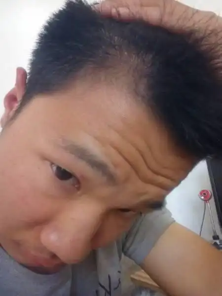 姐妹们这是秃头吗?我的发际线怎么这么奇怪毛发专家解读