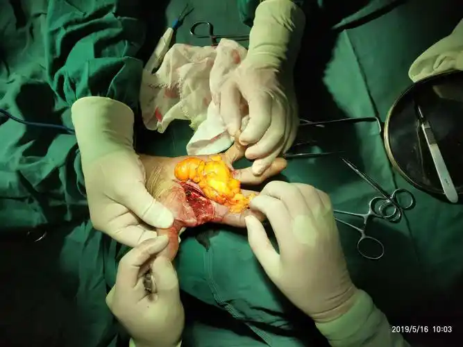 手部巨大脂肪瘤一例!(副本)