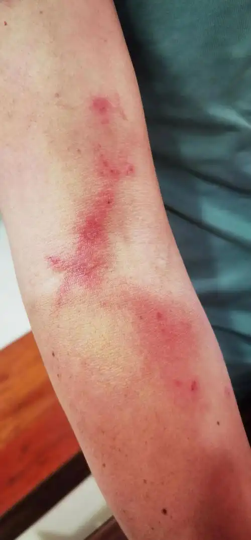 隐翅虫皮炎:夏秋季节的常见皮肤问题