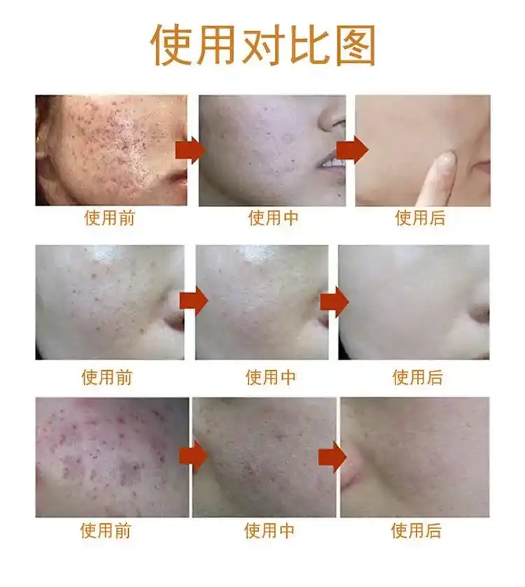 美容院又出黑科技(第一集).五天膜,五天揭膜,五 - 抖音