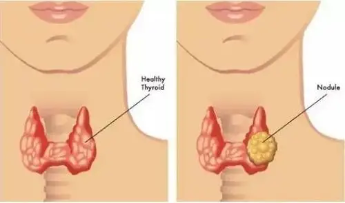 疾病科普丨得了甲状腺瘤先不要慌看看症状再说