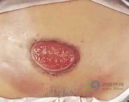 急!阴毛处出现一期梅毒症状