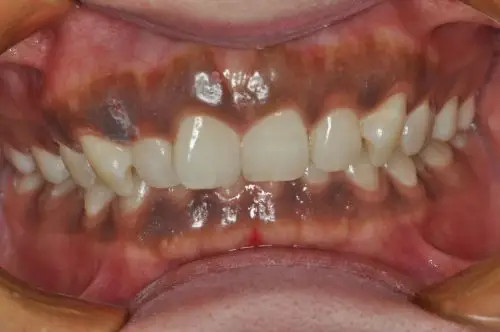 牙龈发黑是什么原因