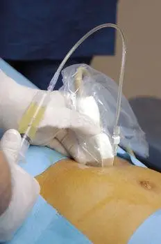 做清洁间歇性导尿的坐轮椅男性患者对导尿管长度偏好性的研究