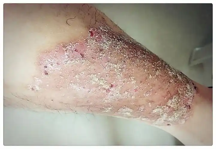 腿癣复病前在长治,襄垣,长治县等地看过多家专治皮肤病诊所