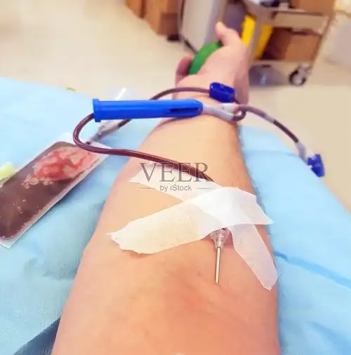 在医院进行血浆置换时献血者的手臂照片摄影图片