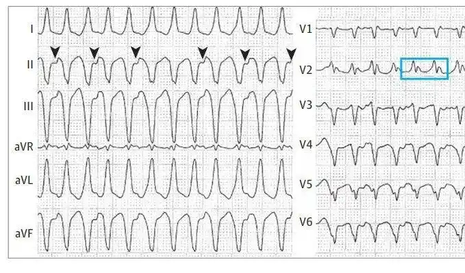 从患者的心电图来看,呈现宽qrs心动过速,胸导联的qrs波的几乎一致负向