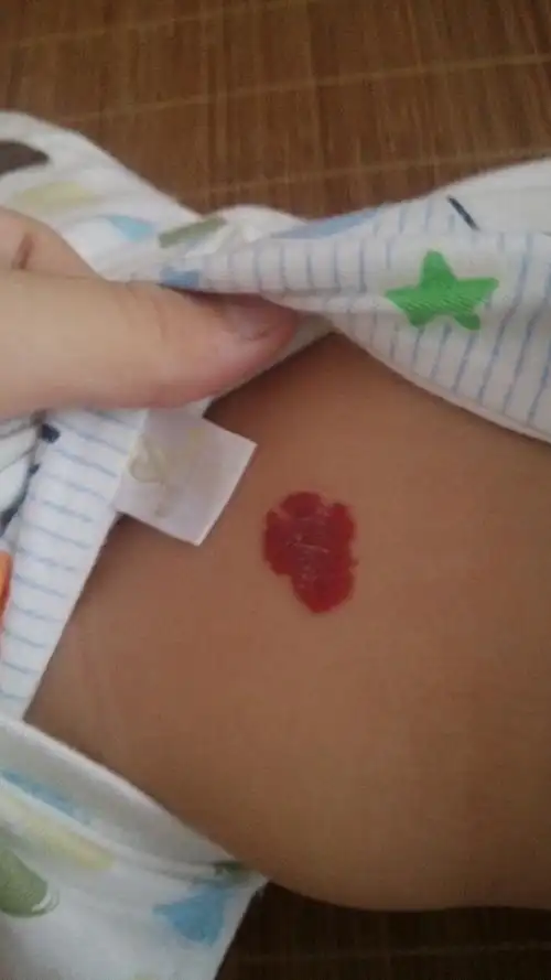 我家宝宝属于哪种类型血管瘤,应该怎么治.