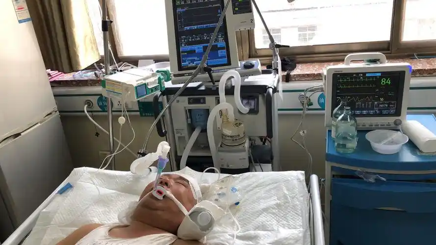 病人脑梗死溶栓出血,脑出血微创引流术后持续气管插管,呼吸机辅助呼吸