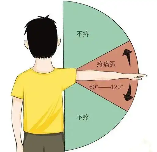 肩痛,还认为是肩周炎?谨防肩袖损伤!