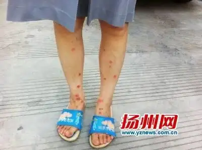 了一个难题:他们的家里总是莫名其妙地出现虱子,腿上被咬了成片的包